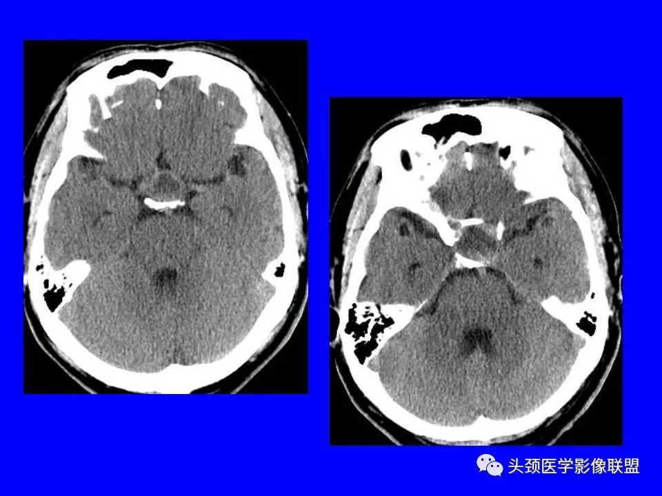 影像PPT - 【PPT】鞍区病变影像诊断-68
