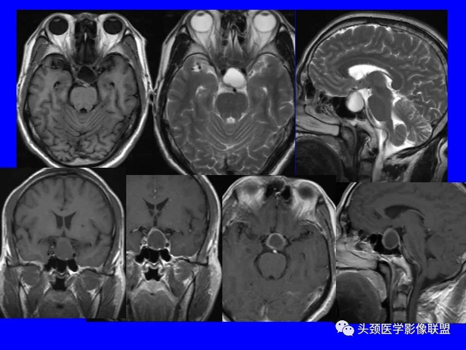 影像PPT - 【PPT】鞍区病变影像诊断-69