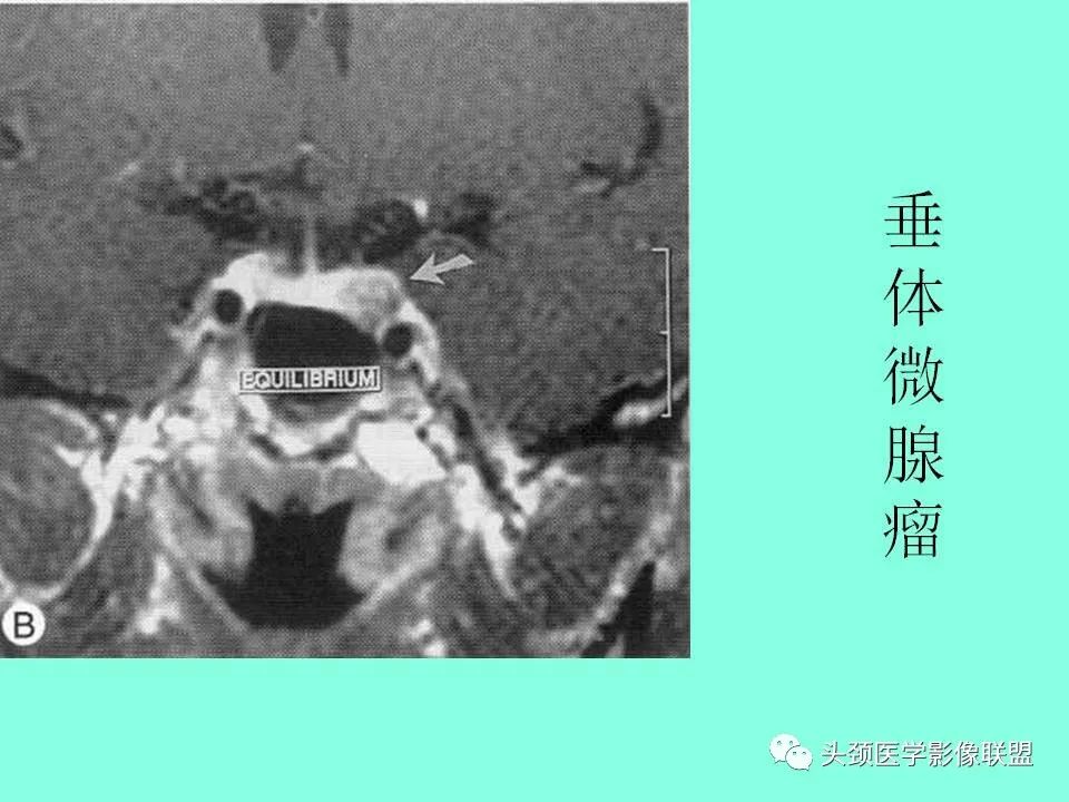 影像PPT - 【PPT】鞍区病变影像诊断-71