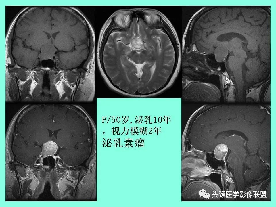 影像PPT - 【PPT】鞍区病变影像诊断-73
