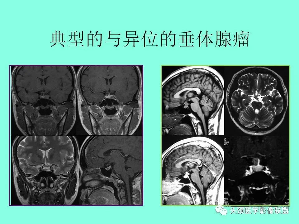 影像PPT - 【PPT】鞍区病变影像诊断-72