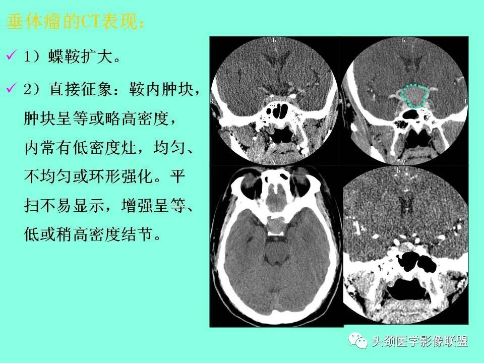 影像PPT - 【PPT】鞍区病变影像诊断-79