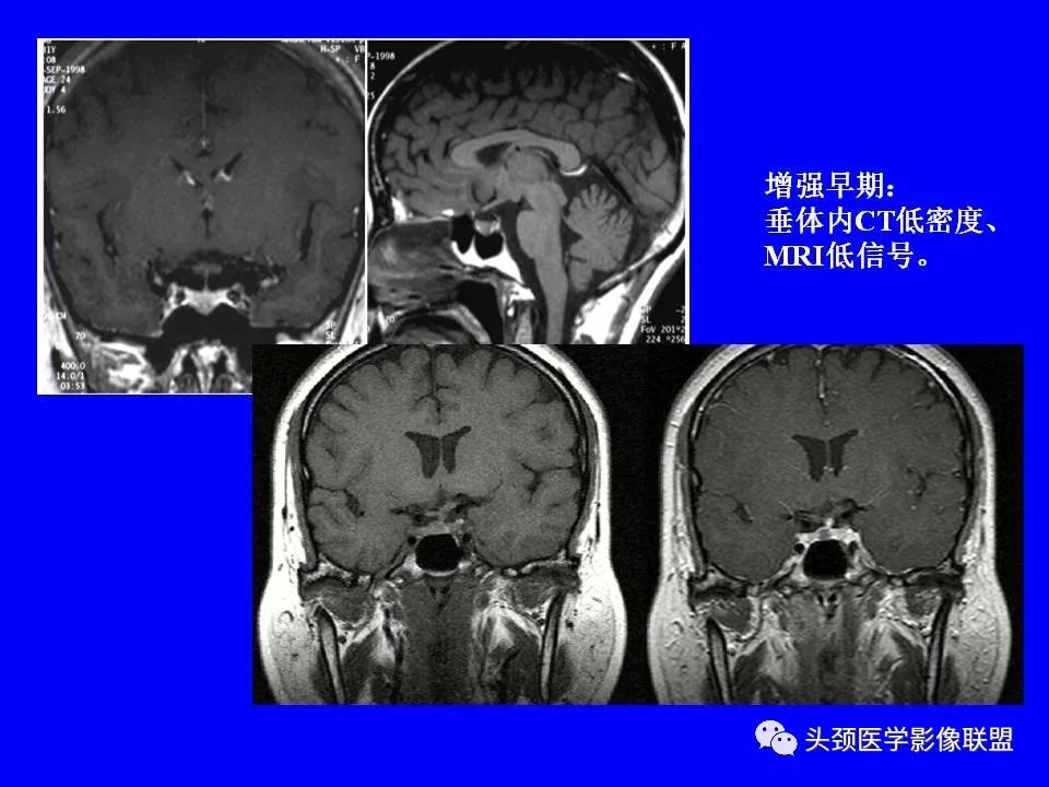 影像PPT - 【PPT】鞍区病变影像诊断-76