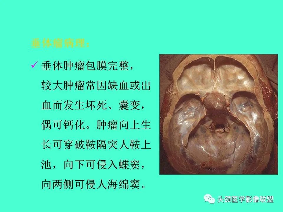 影像PPT - 【PPT】鞍区病变影像诊断-78