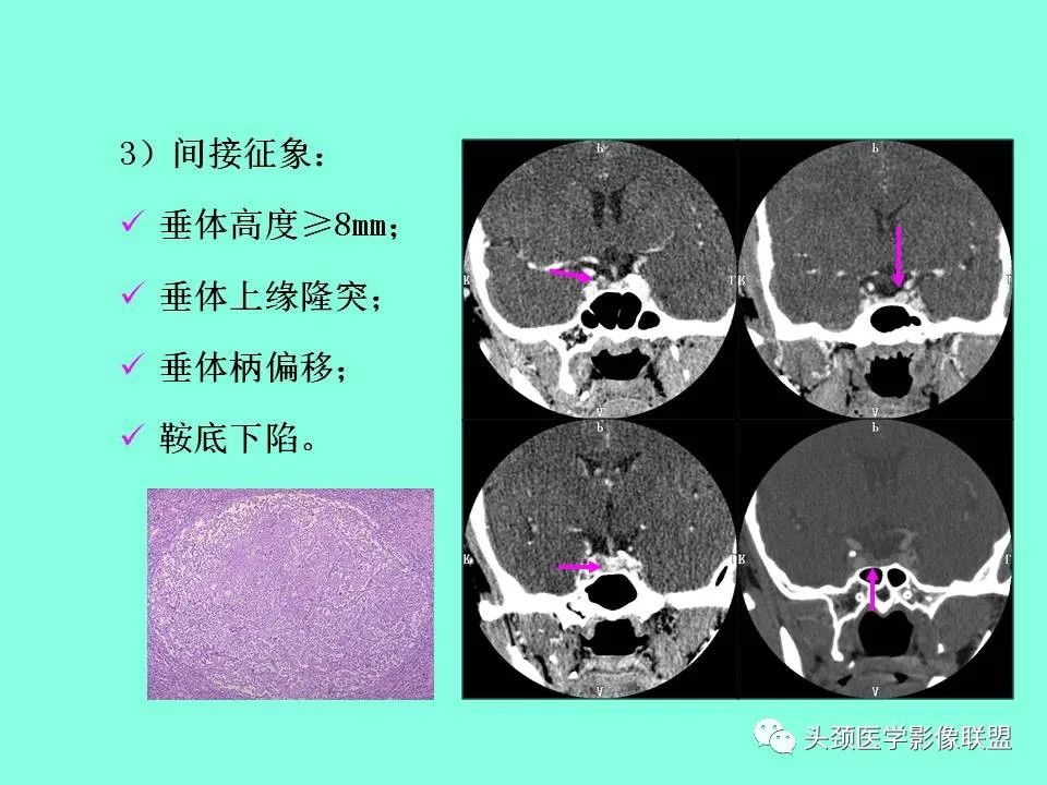 影像PPT - 【PPT】鞍区病变影像诊断-80