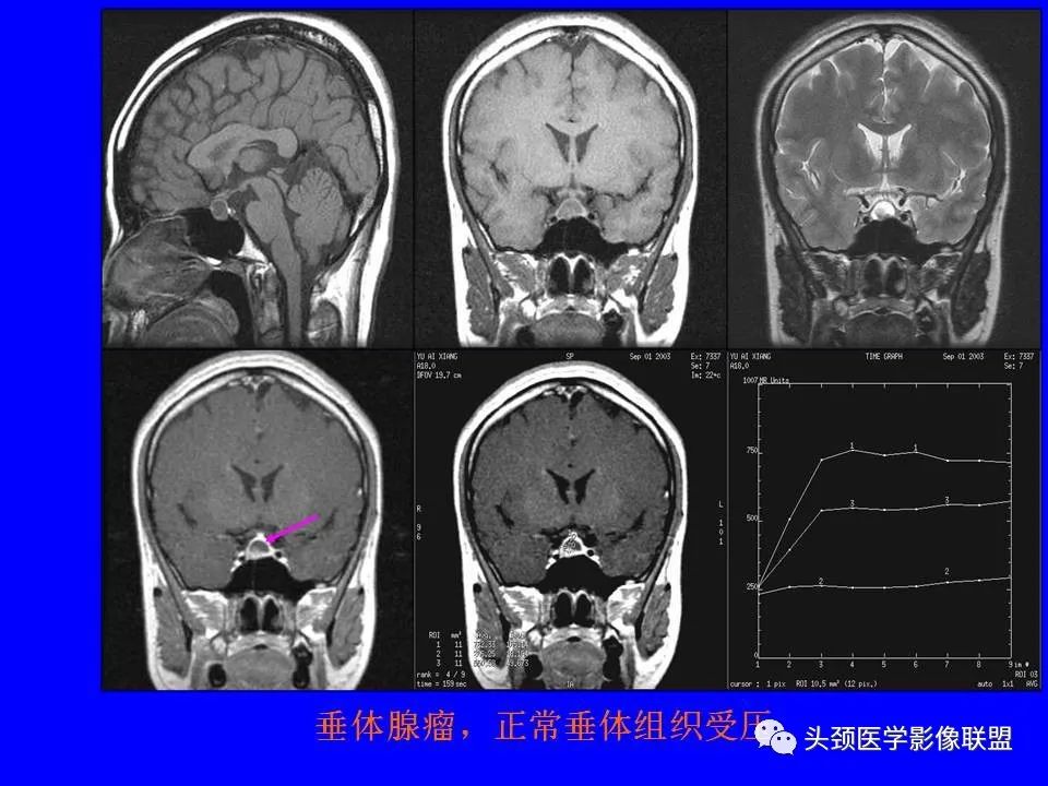 影像PPT - 【PPT】鞍区病变影像诊断-83