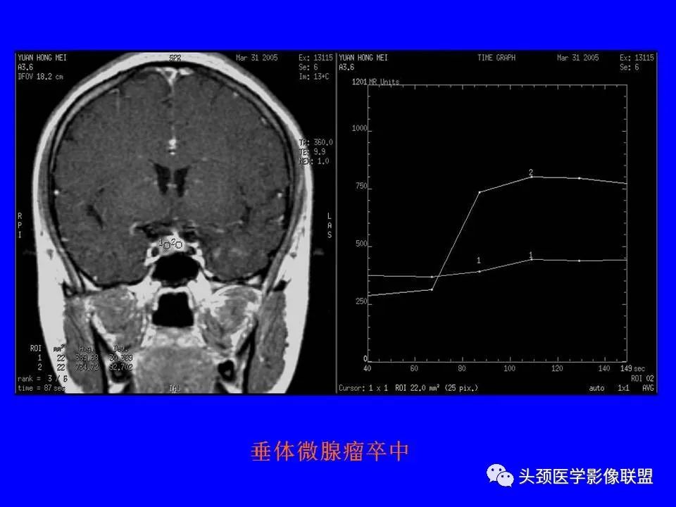 影像PPT - 【PPT】鞍区病变影像诊断-82