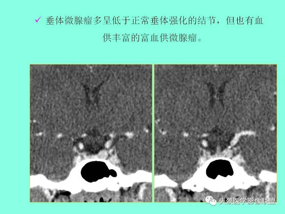 影像PPT - 【PPT】鞍区病变影像诊断-84