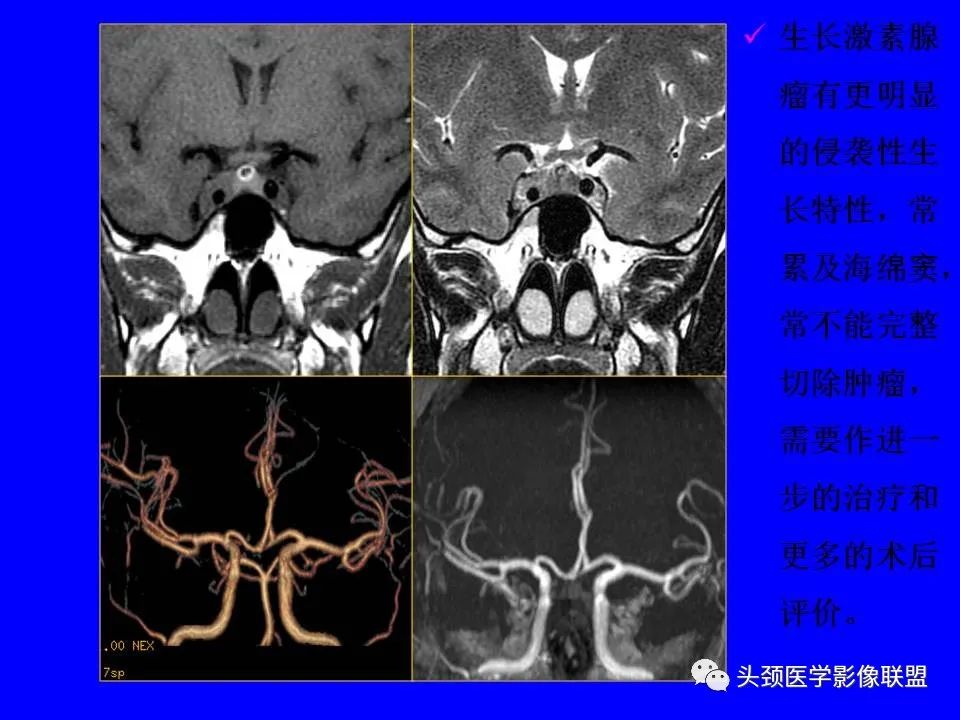 影像PPT - 【PPT】鞍区病变影像诊断-86