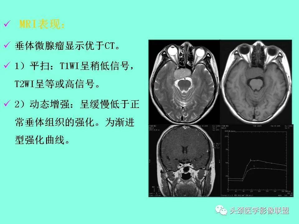 影像PPT - 【PPT】鞍区病变影像诊断-81