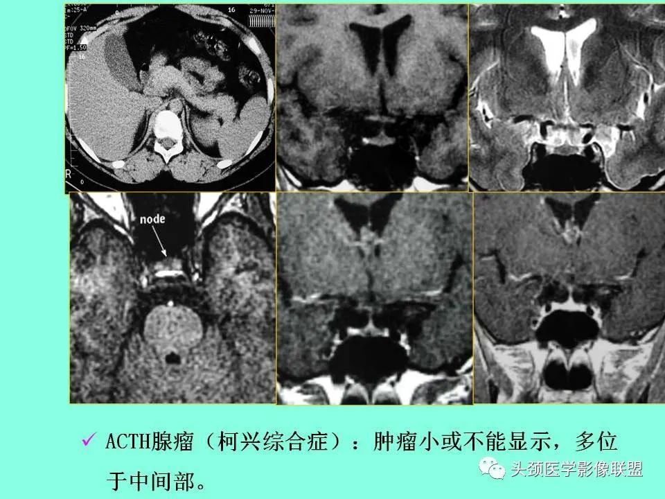 影像PPT - 【PPT】鞍区病变影像诊断-87