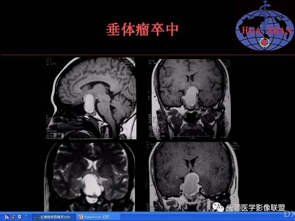 影像PPT - 【PPT】鞍区病变影像诊断-90
