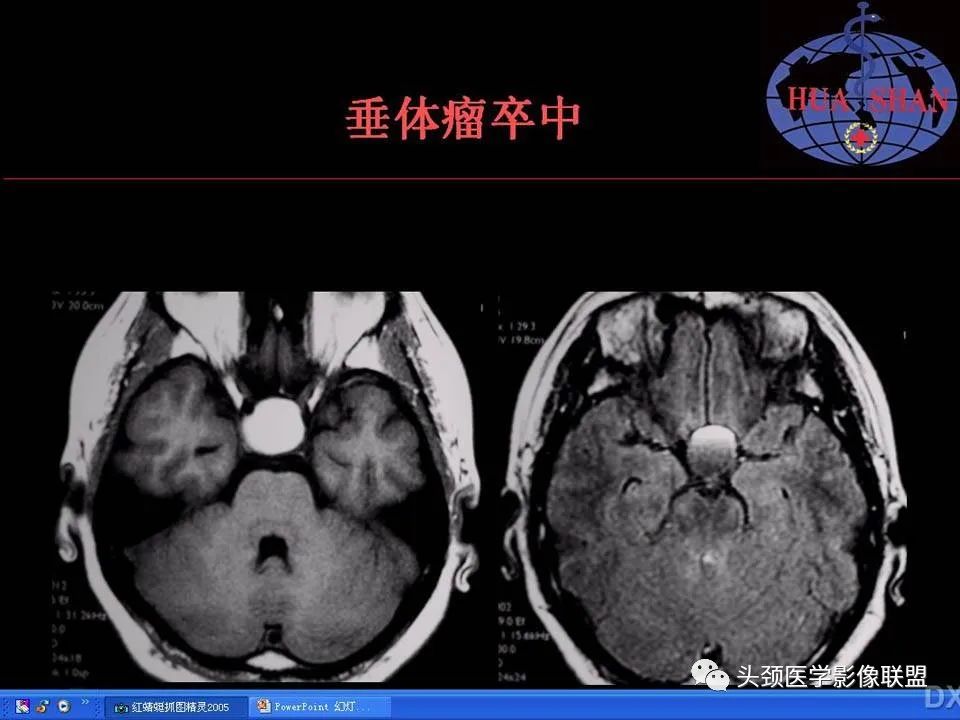 影像PPT - 【PPT】鞍区病变影像诊断-91