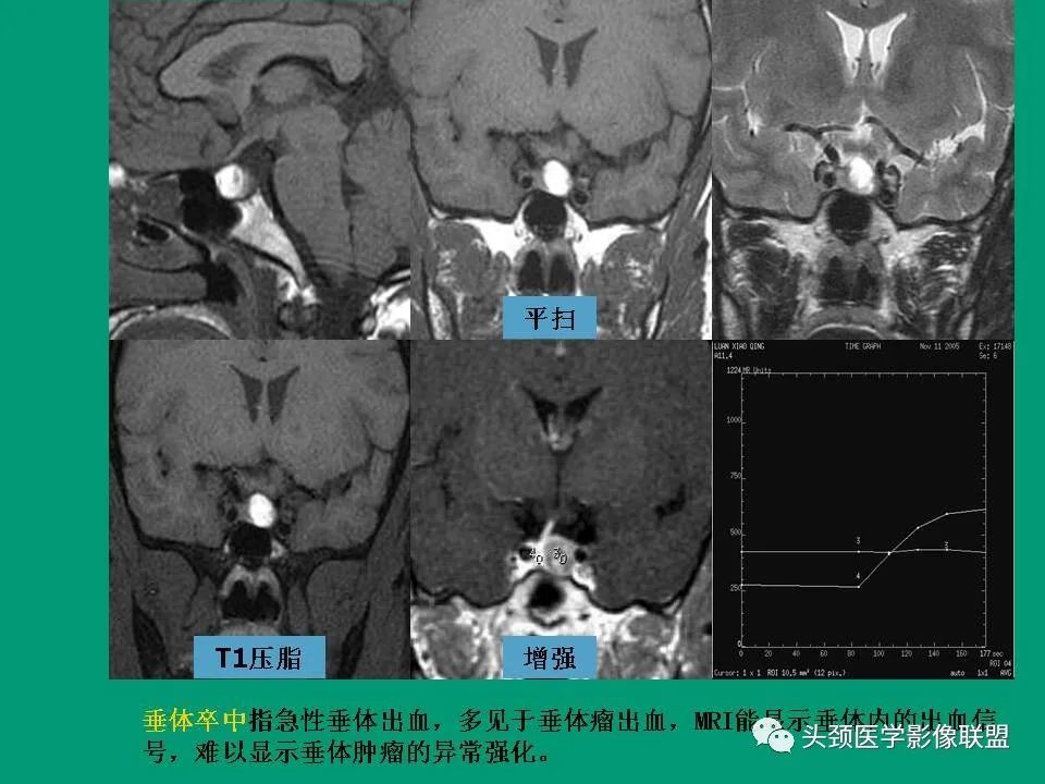 影像PPT - 【PPT】鞍区病变影像诊断-88