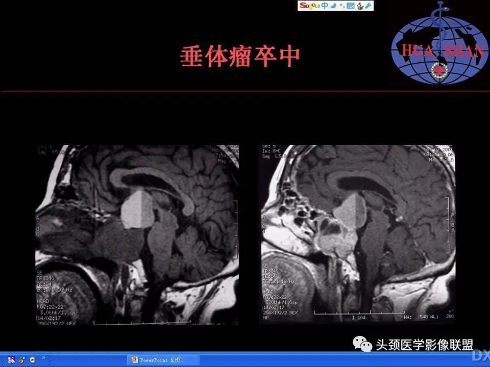 影像PPT - 【PPT】鞍区病变影像诊断-92