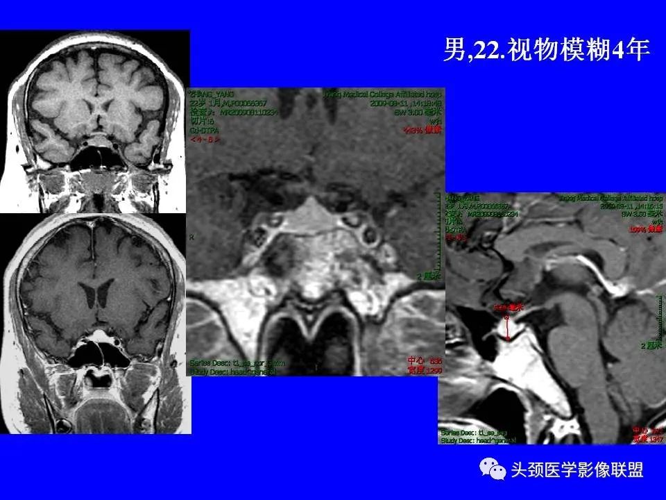 影像PPT - 【PPT】鞍区病变影像诊断-93