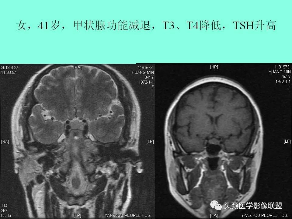 影像PPT - 【PPT】鞍区病变影像诊断-94