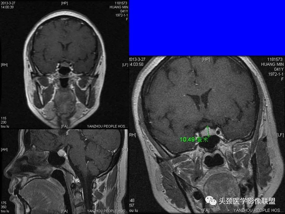 影像PPT - 【PPT】鞍区病变影像诊断-95