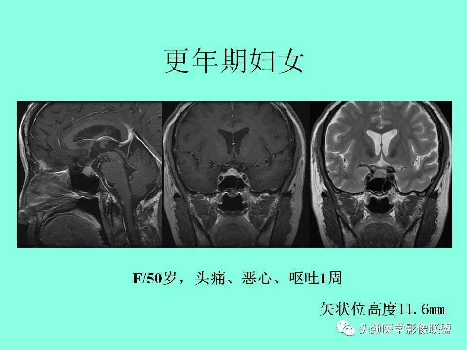 影像PPT - 【PPT】鞍区病变影像诊断-97