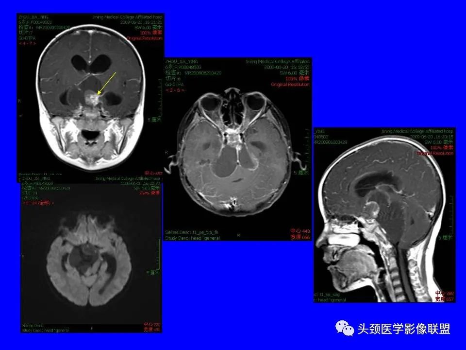 影像PPT - 【PPT】鞍区病变影像诊断-102