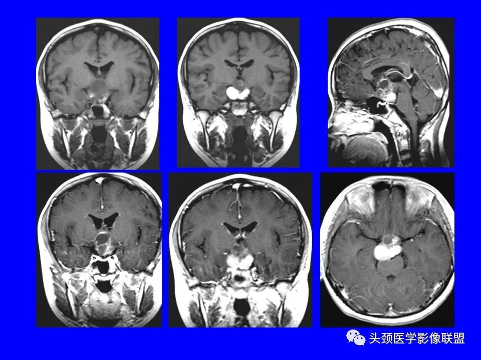 影像PPT - 【PPT】鞍区病变影像诊断-103