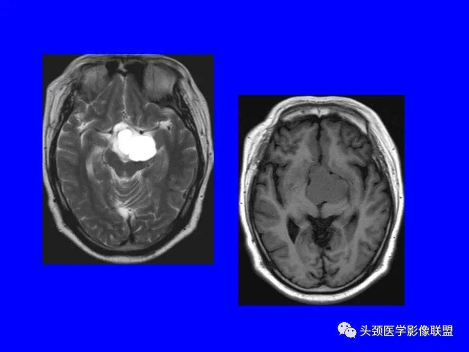 影像PPT - 【PPT】鞍区病变影像诊断-101