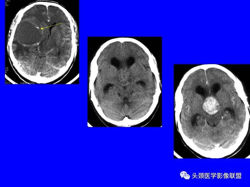 影像PPT - 【PPT】鞍区病变影像诊断-100