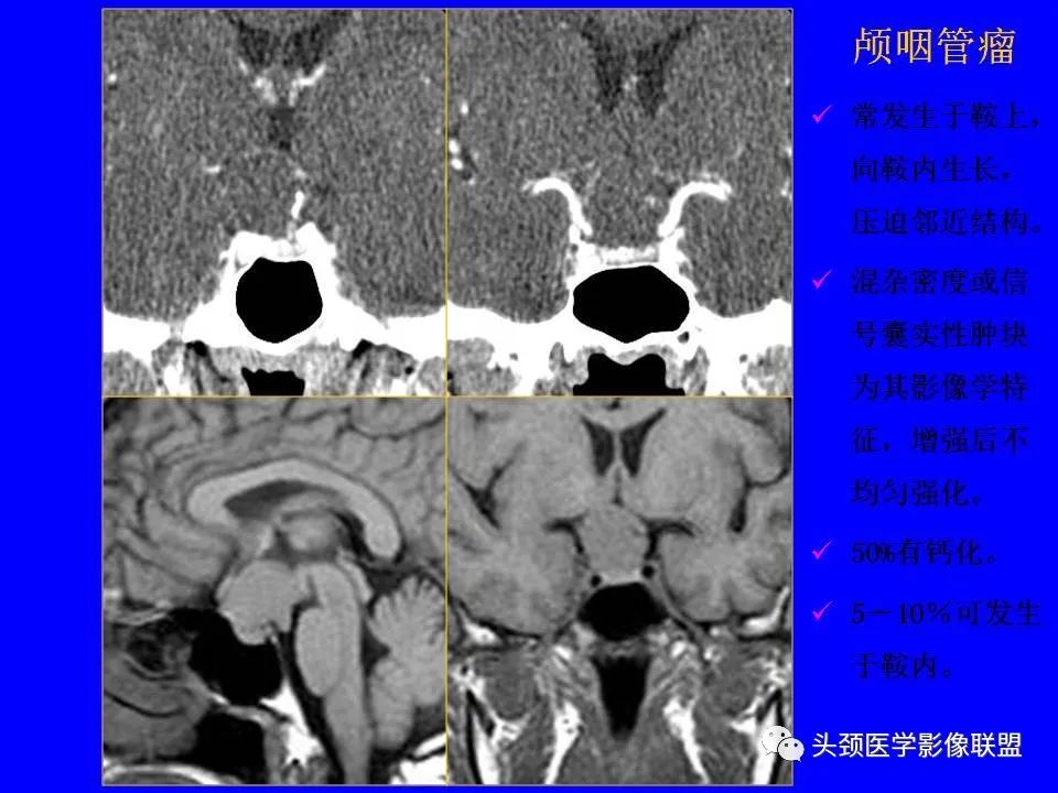 影像PPT - 【PPT】鞍区病变影像诊断-108