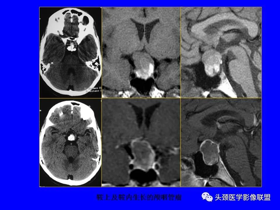 影像PPT - 【PPT】鞍区病变影像诊断-109