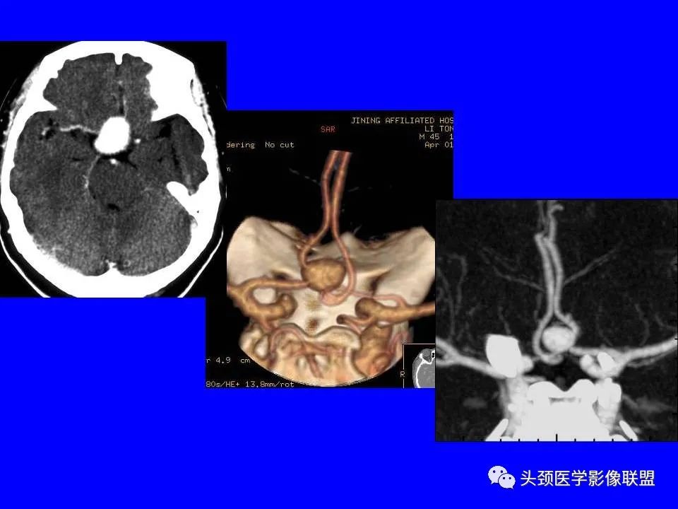 影像PPT - 【PPT】鞍区病变影像诊断-111