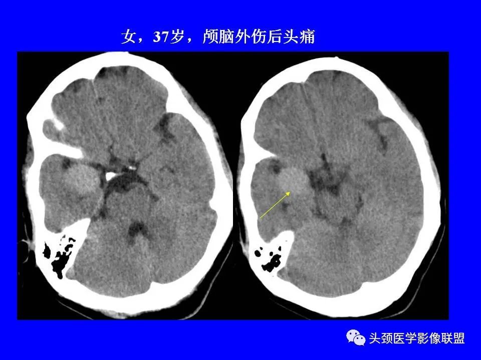影像PPT - 【PPT】鞍区病变影像诊断-114