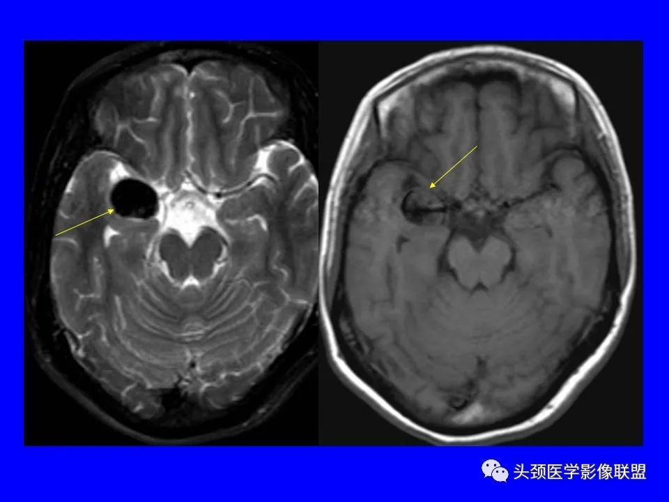 影像PPT - 【PPT】鞍区病变影像诊断-115