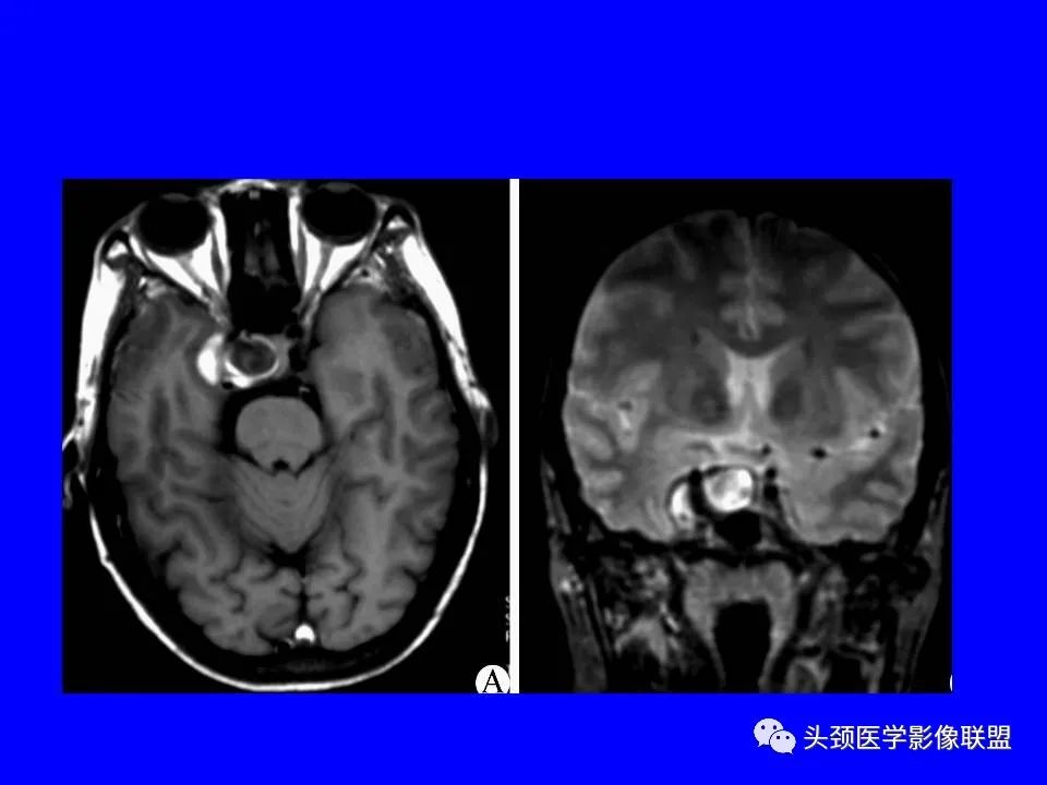 影像PPT - 【PPT】鞍区病变影像诊断-112