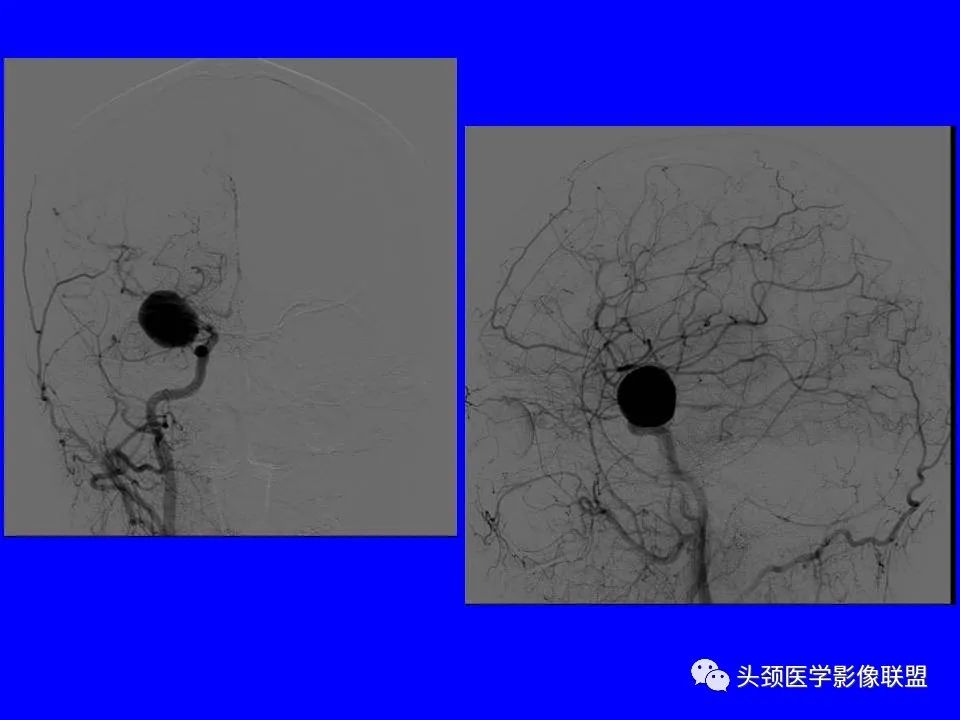 影像PPT - 【PPT】鞍区病变影像诊断-116