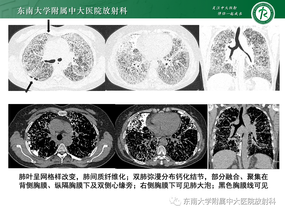 影像PPT - 【PPT】肺泡微石症-2