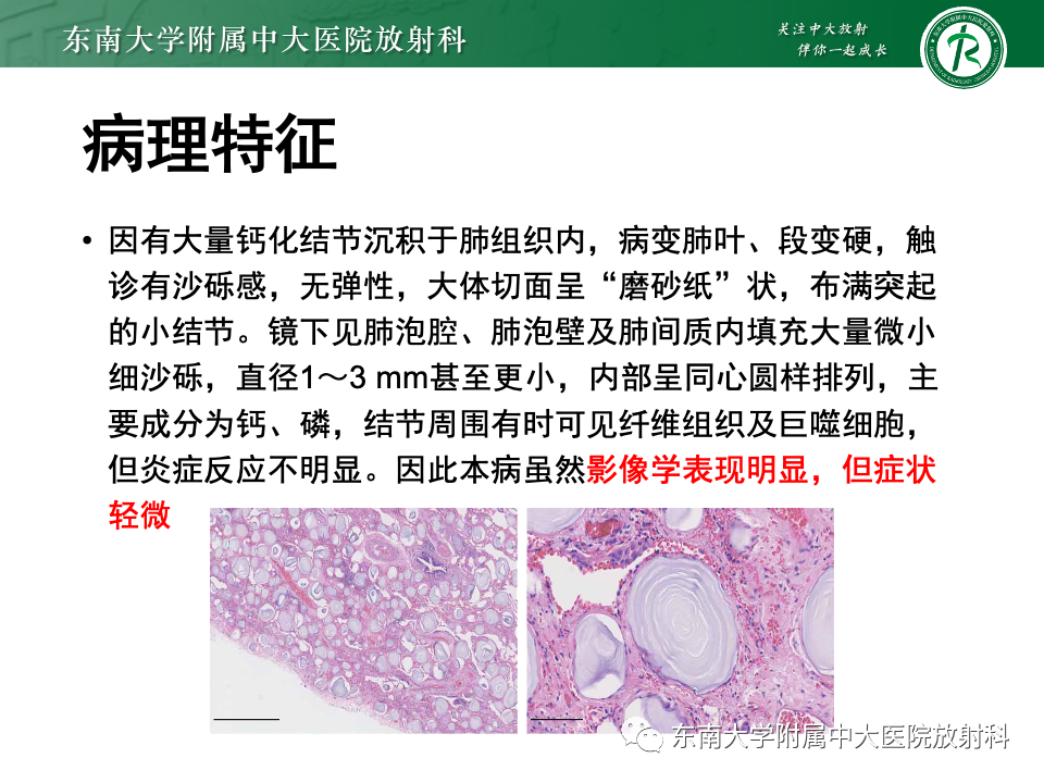 影像PPT - 【PPT】肺泡微石症-6