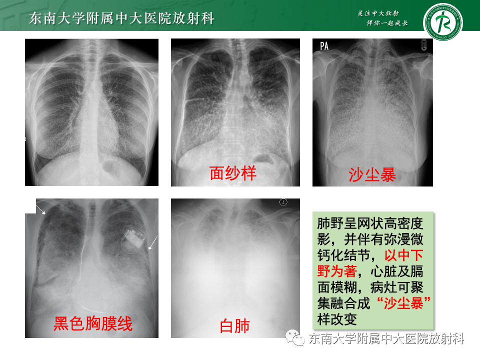 影像PPT - 【PPT】肺泡微石症-10