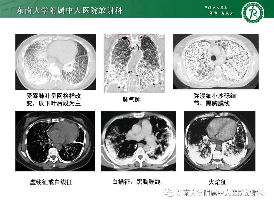影像PPT - 【PPT】肺泡微石症-12