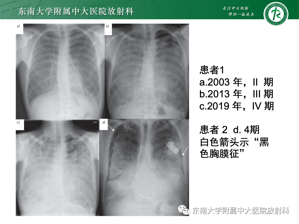 影像PPT - 【PPT】肺泡微石症-14
