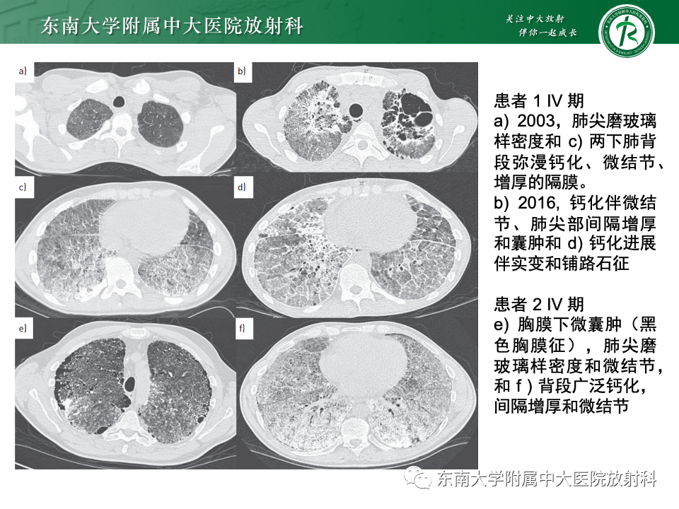 影像PPT - 【PPT】肺泡微石症-15