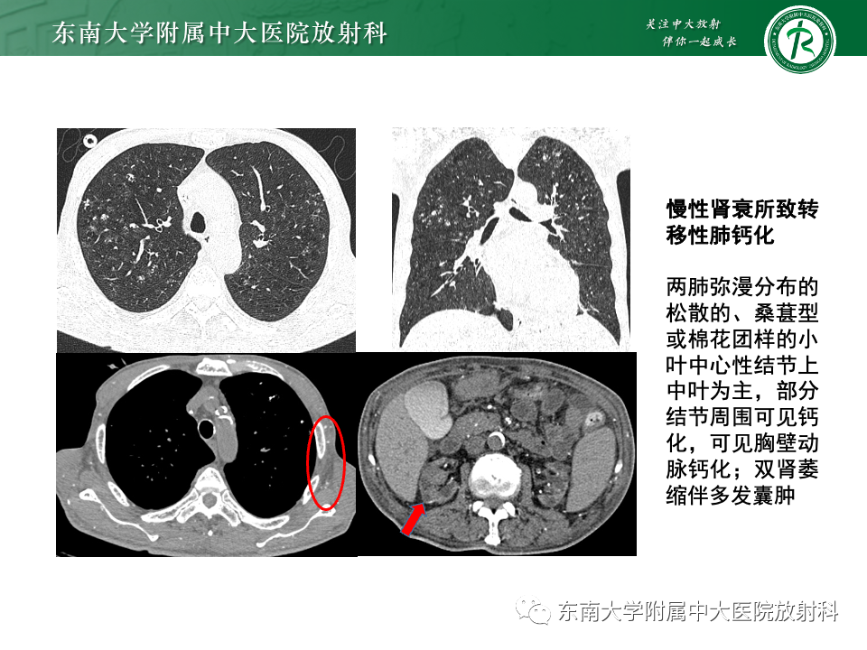 影像PPT - 【PPT】肺泡微石症-22