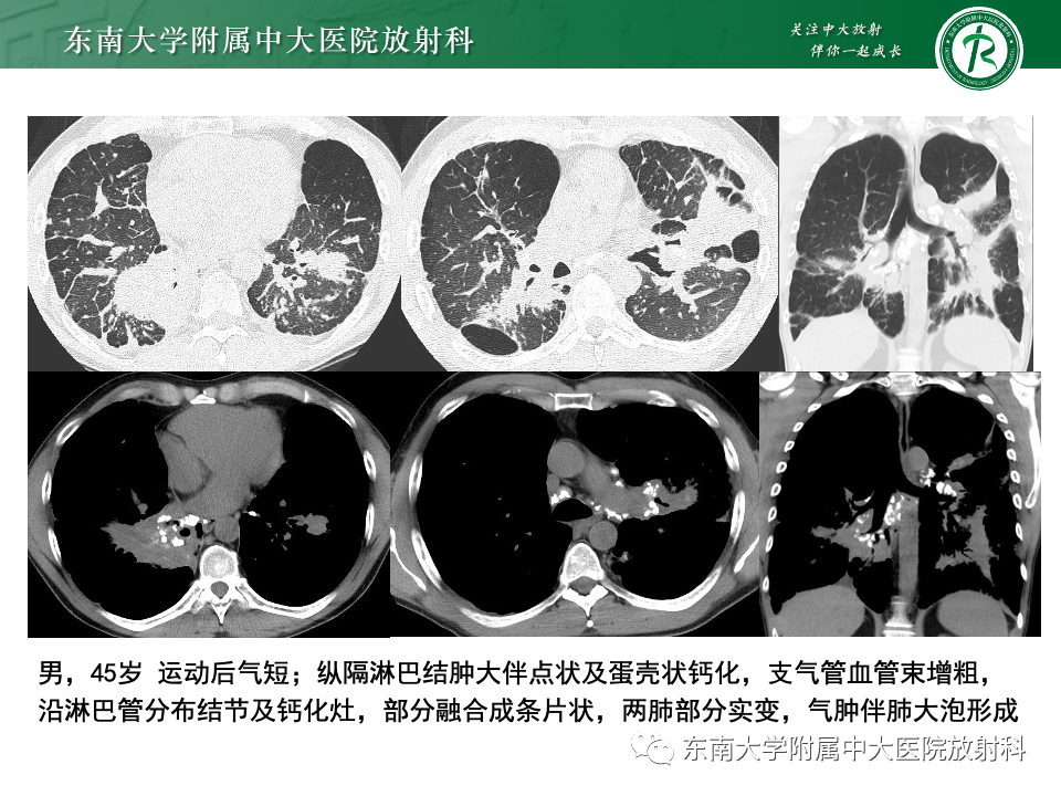 影像PPT - 【PPT】肺泡微石症-27