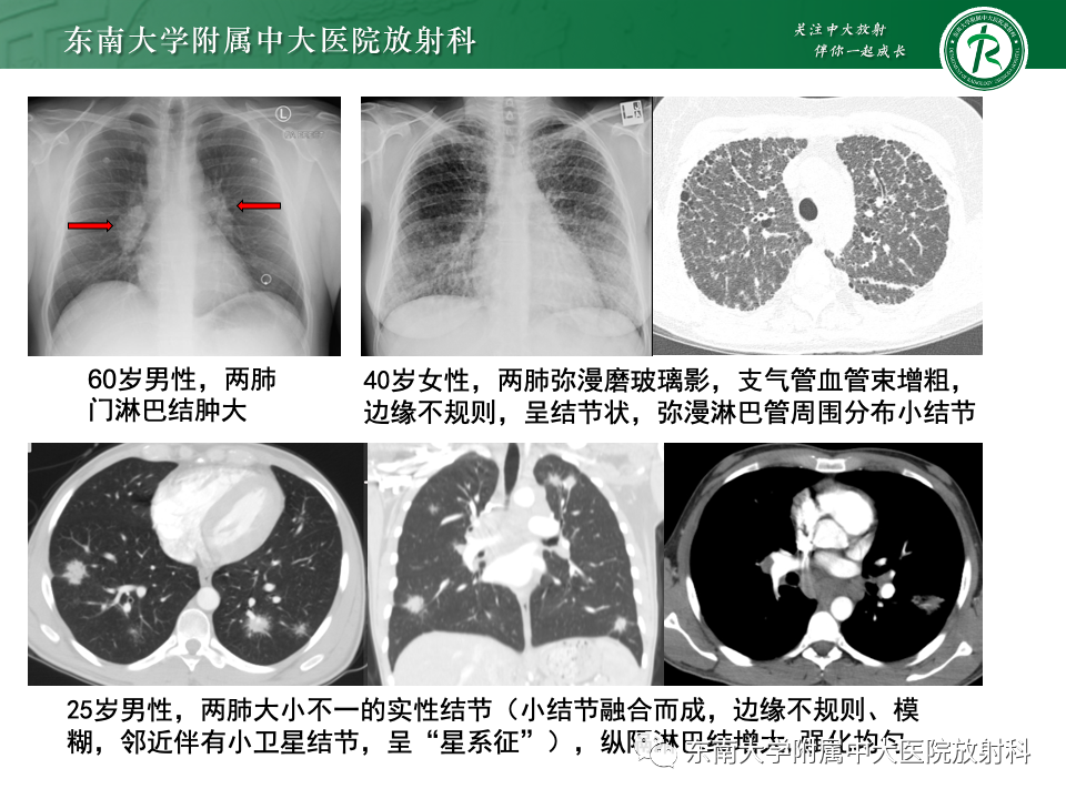影像PPT - 【PPT】肺泡微石症-28