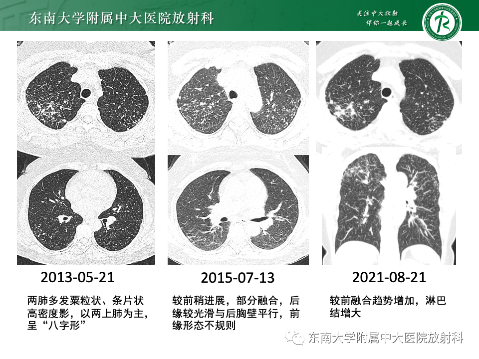 影像PPT - 【PPT】肺泡微石症-32