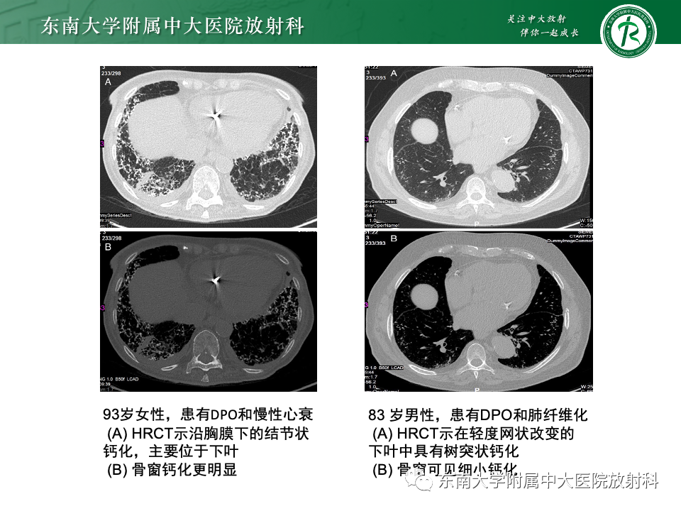 影像PPT - 【PPT】肺泡微石症-34
