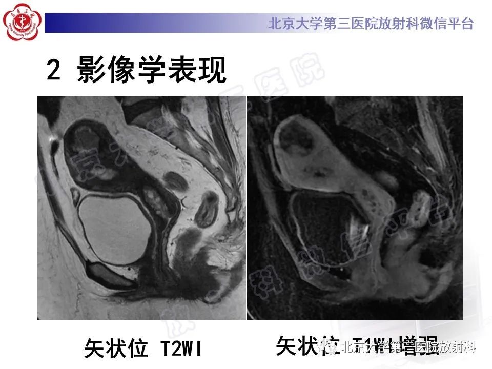 影像PPT - 【PPT】子宫内膜间质肉瘤-3