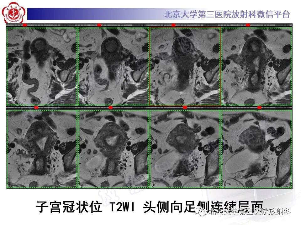 影像PPT - 【PPT】子宫内膜间质肉瘤-5
