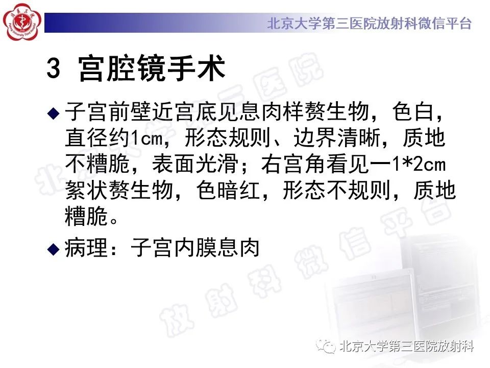 影像PPT - 【PPT】子宫内膜间质肉瘤-7