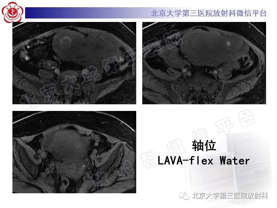 影像PPT - 【PPT】子宫内膜间质肉瘤-10