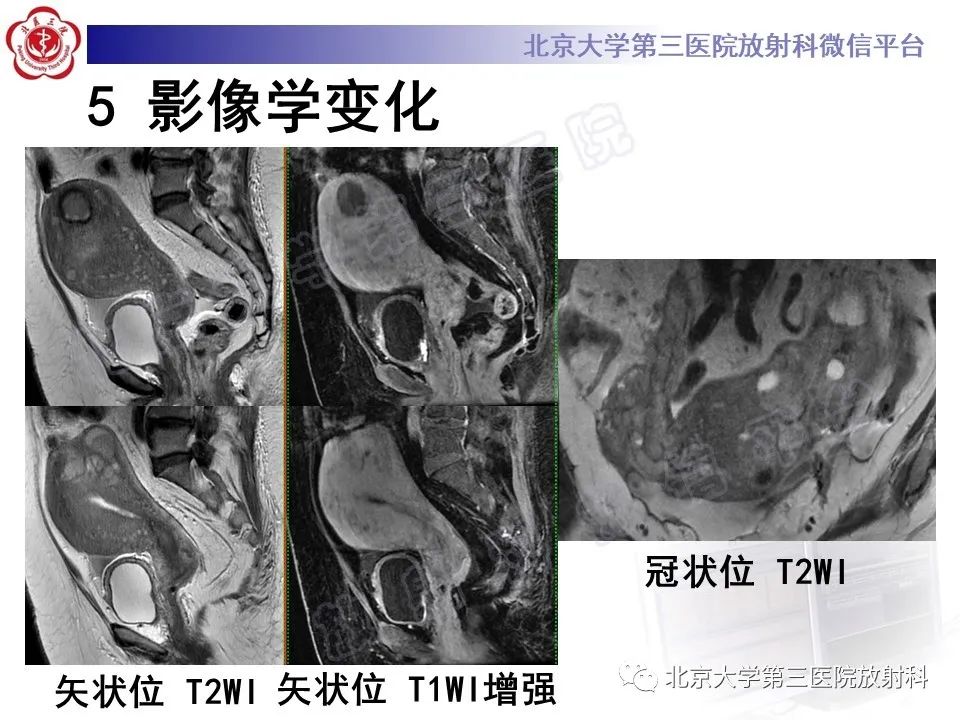 影像PPT - 【PPT】子宫内膜间质肉瘤-9